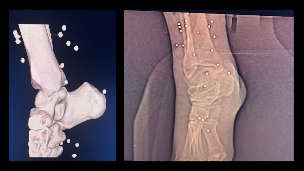 Shotgun pellets in the foot area of a patient seen in CT scan and X-ray images