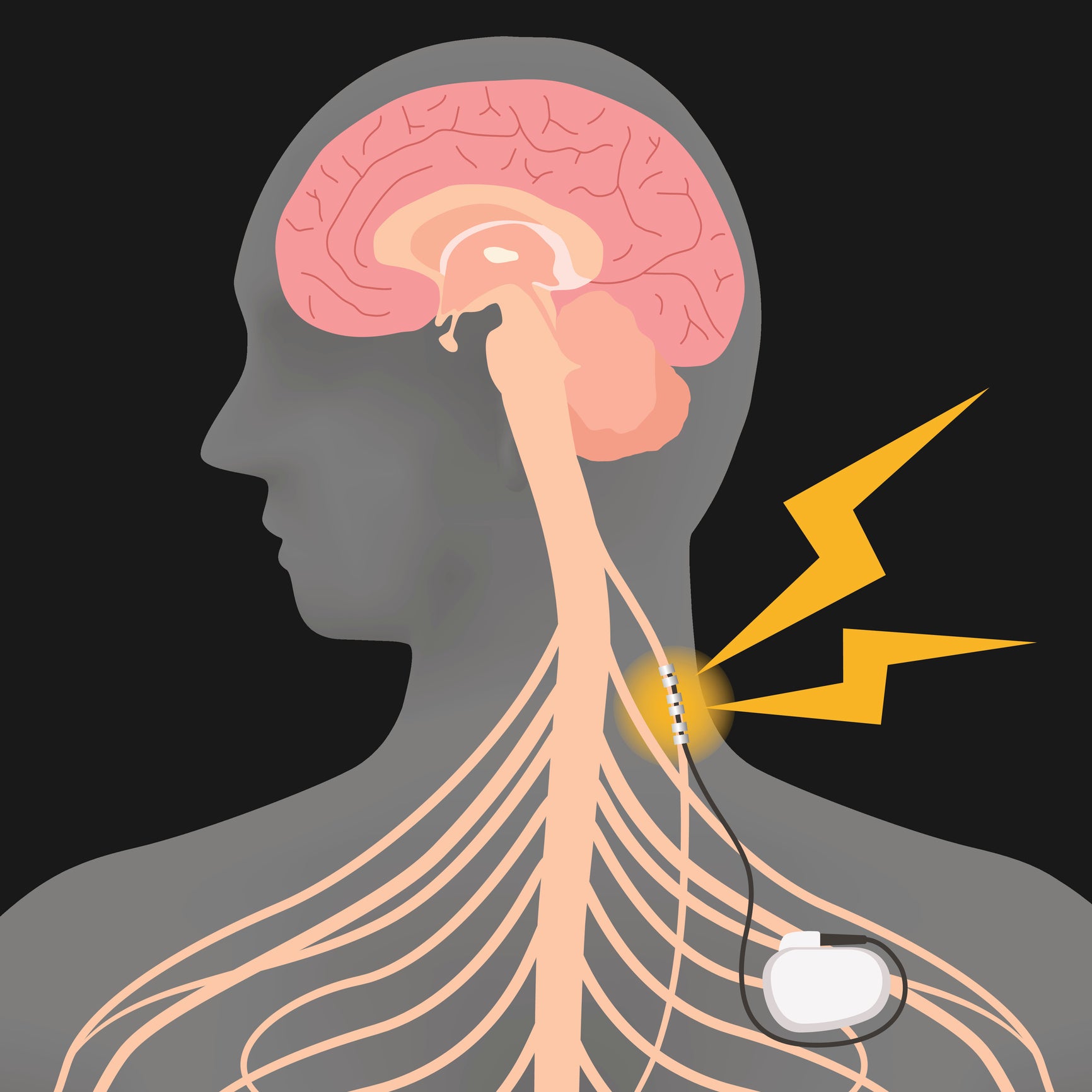 Vagus nerve stimulation involves surgically implanting a small pacemaker-like device in the chest, with wires wrapped around the vagus nerve in the neck.