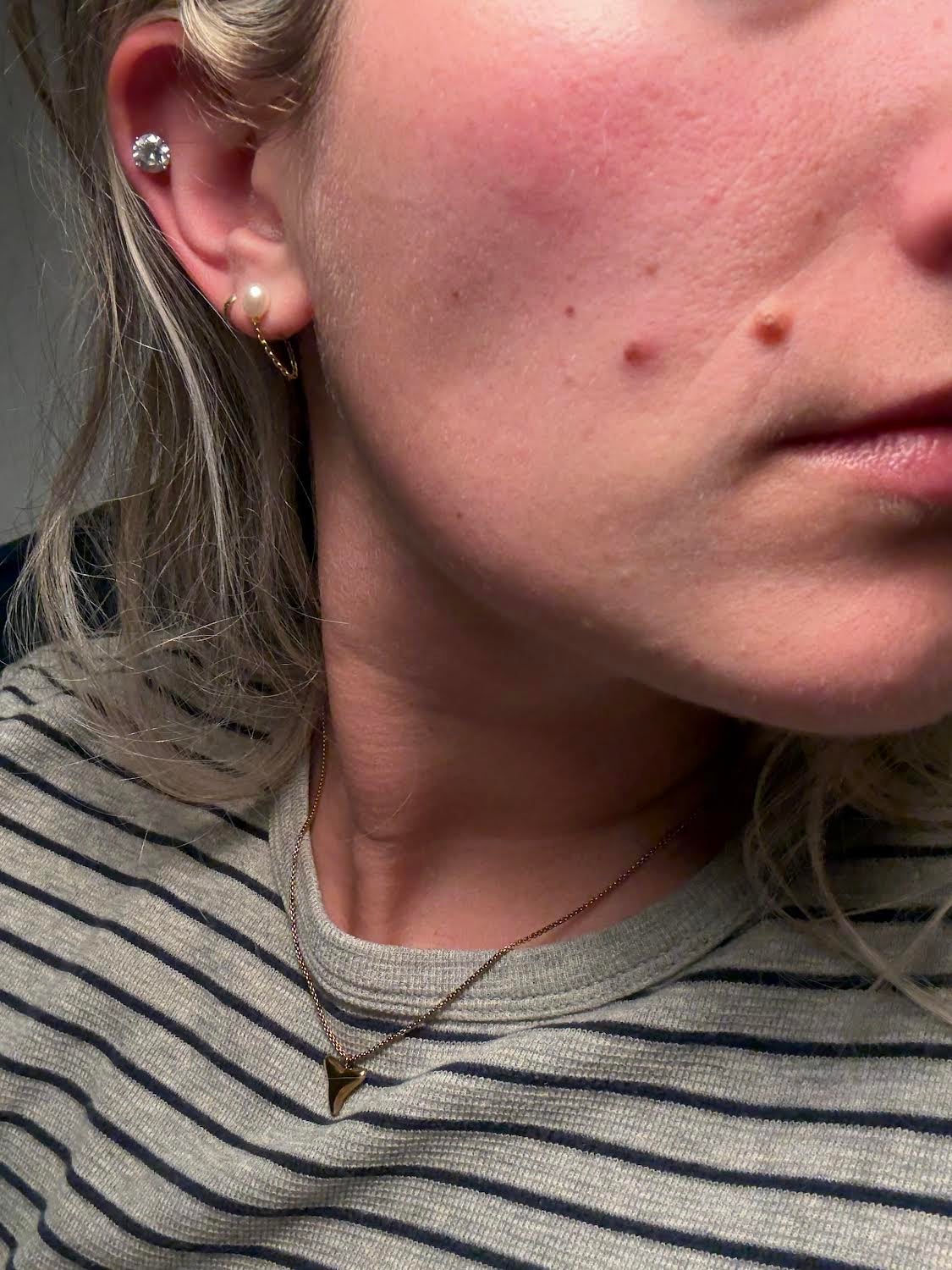 Musto's mole (bottom center) is seen after the changes