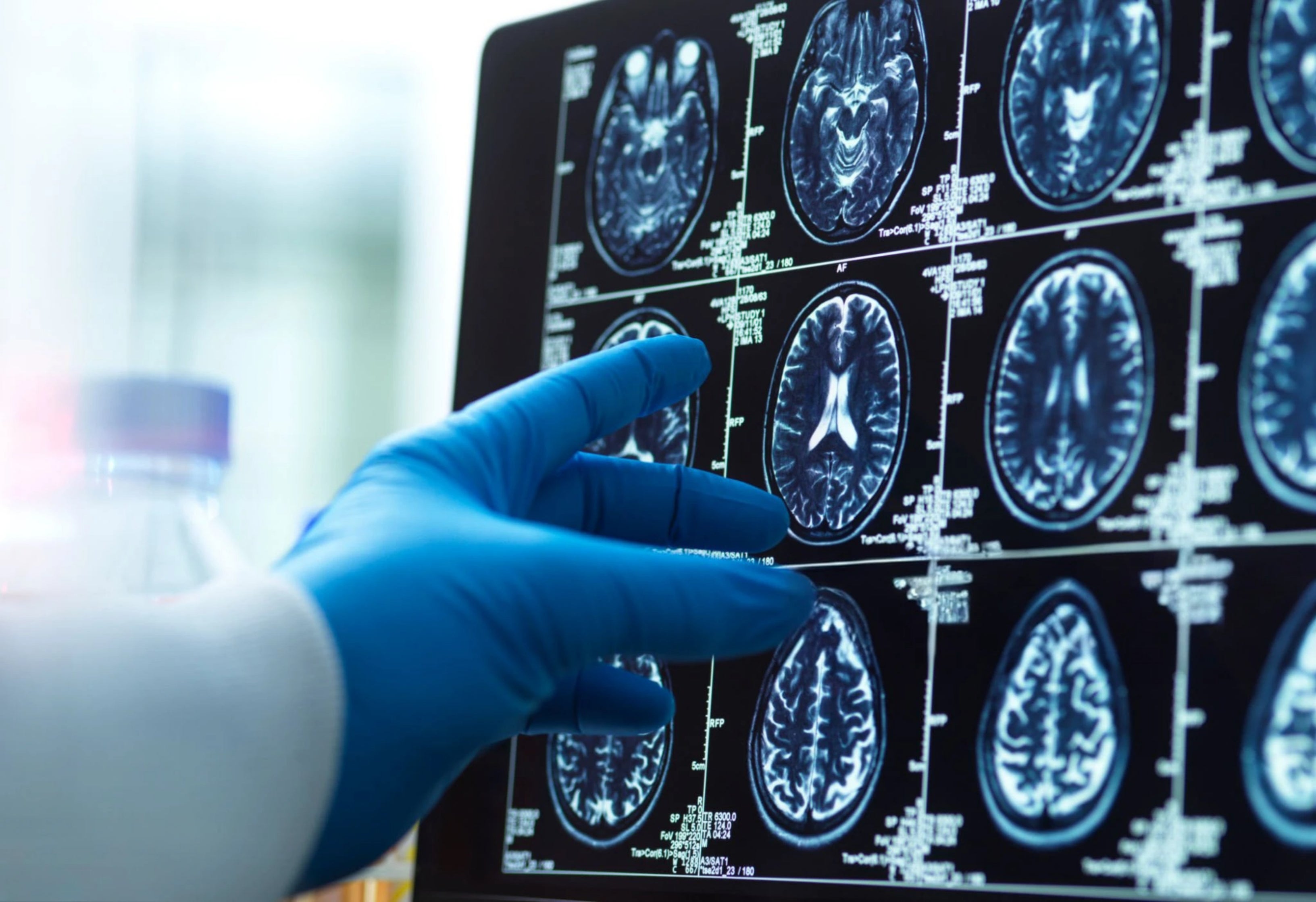 Dementia becomes leading cause of death in Australia as experts call for ‘shift in thinking’ about disease