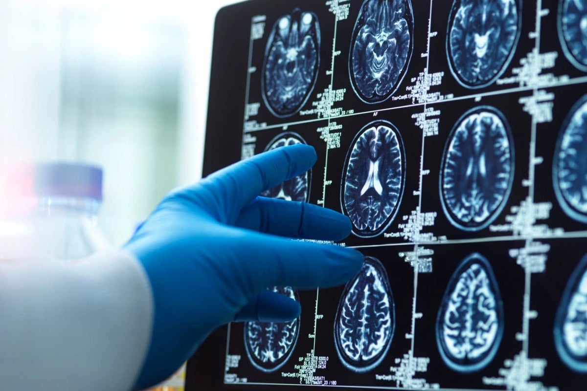The common brain disorder often dismissed as being ‘all in your head’