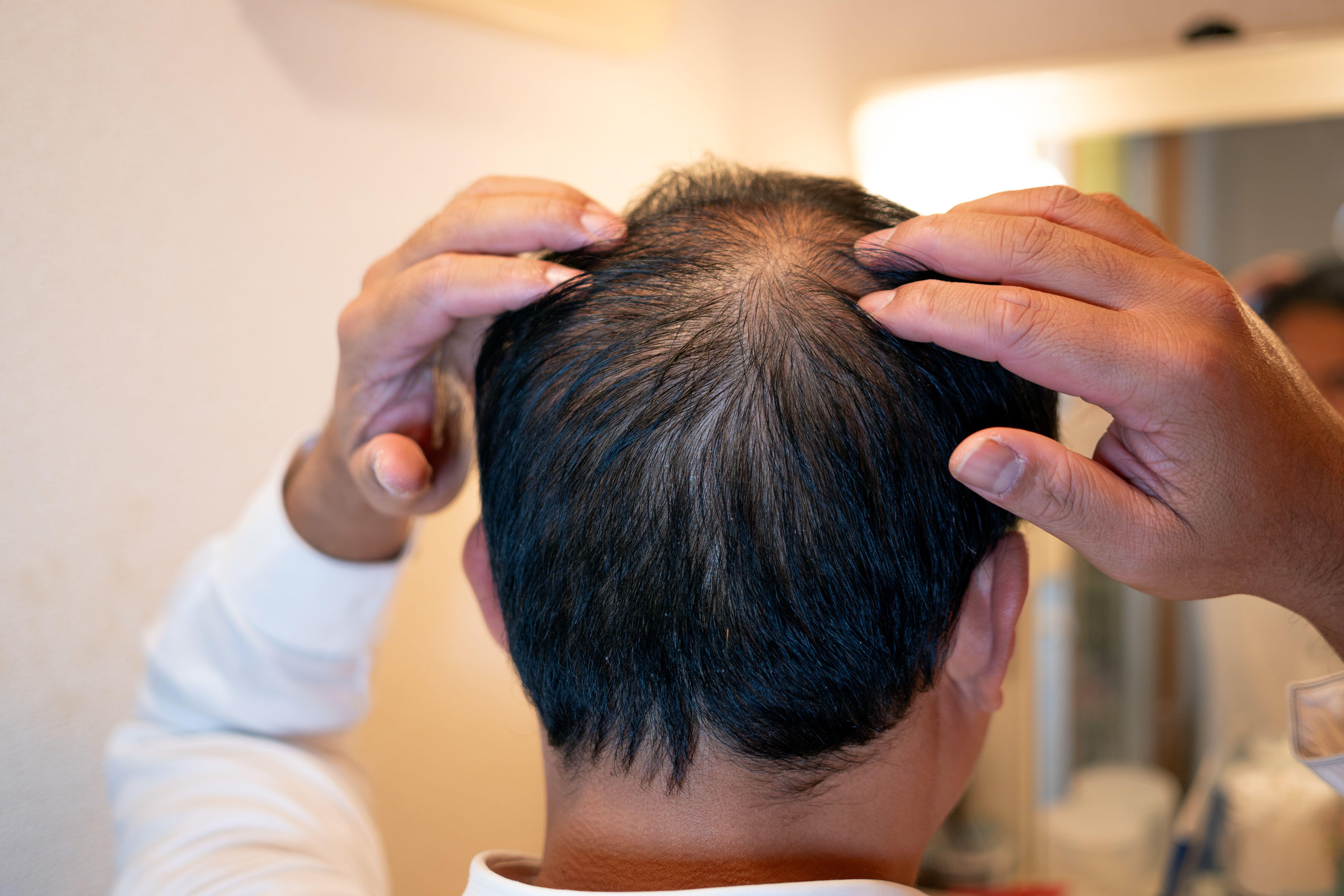 Patches of more visible scalp often indicate hair loss