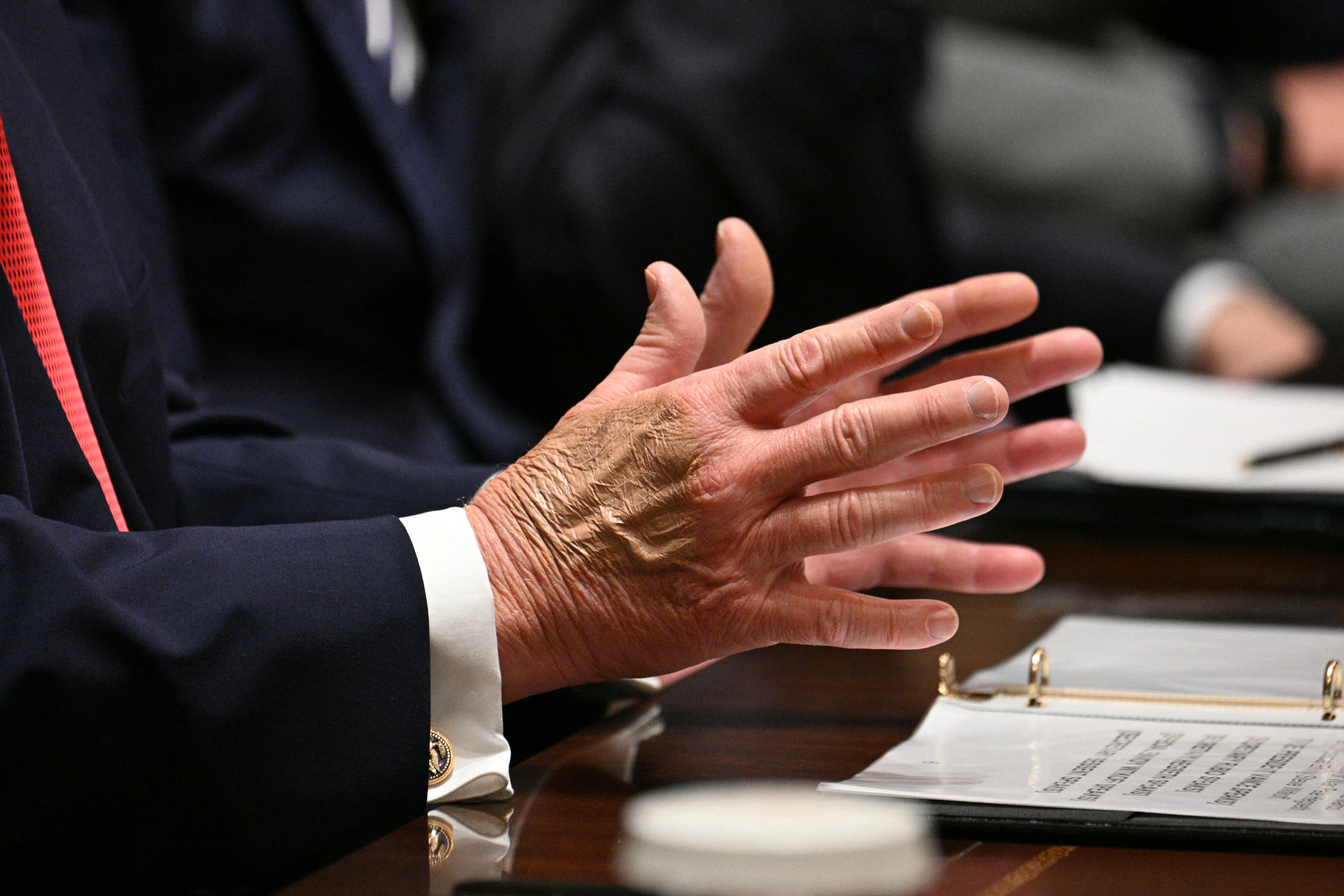 The president’s often bruised and makeup-covered hands, arsenic good arsenic his wont of appearing to autumn dormant during nationalist appearances, has prompted speculation astir his health