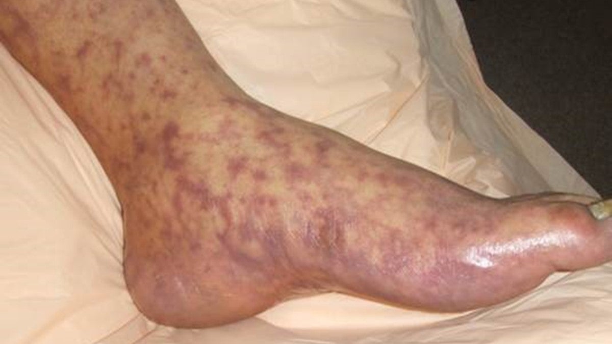 A splotchy red rash from a Rocky Mountain Spotted Fever infection is seen in this photo provided by the U.S. Centers for Disease Control and Prevention