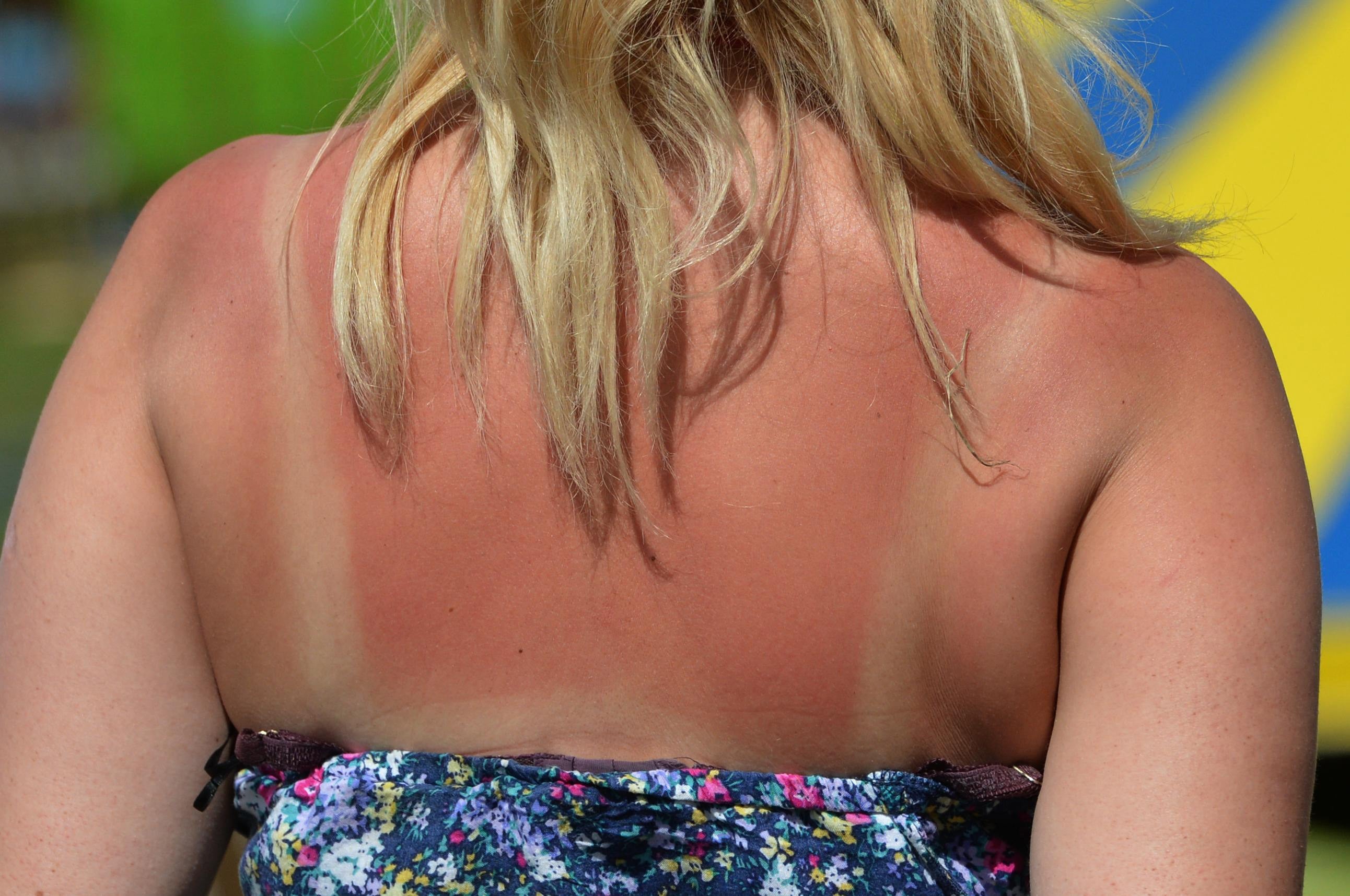 Burn notice: a parliamentary group has given clear recommendations on how we can push for messaging around sun safety