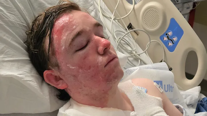 McDonald’s employee left in ‘excruciating’ pain with second-degree burns all over body after co-worker allegedly threw hot oil on him