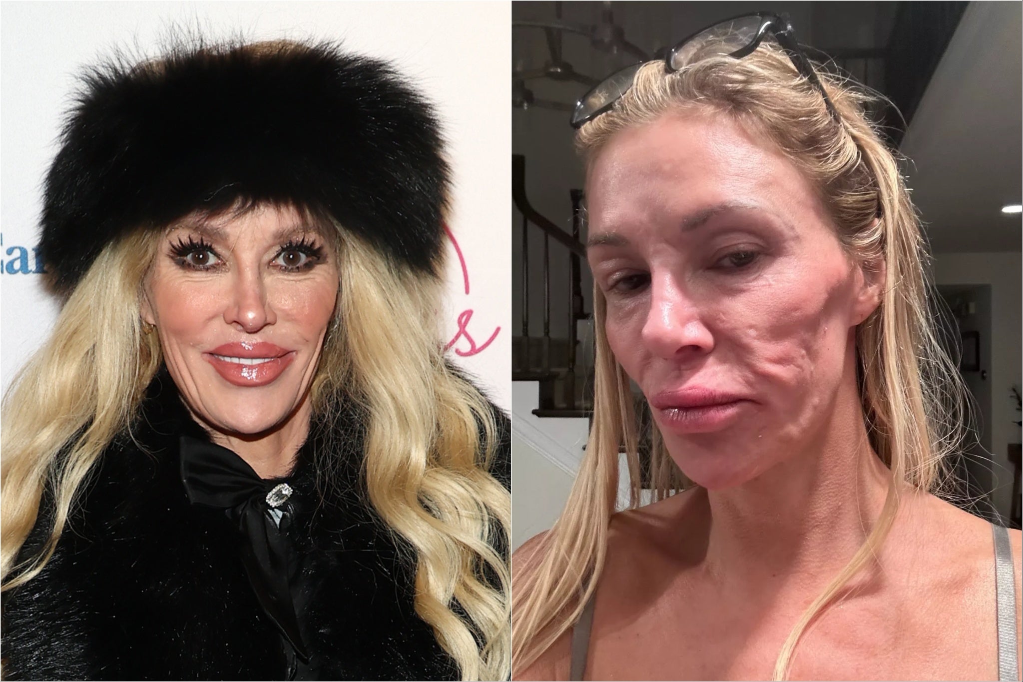 Brandi Glanville is undergoing exploratory surgery in an attempt to diagnose her mystery skin condition