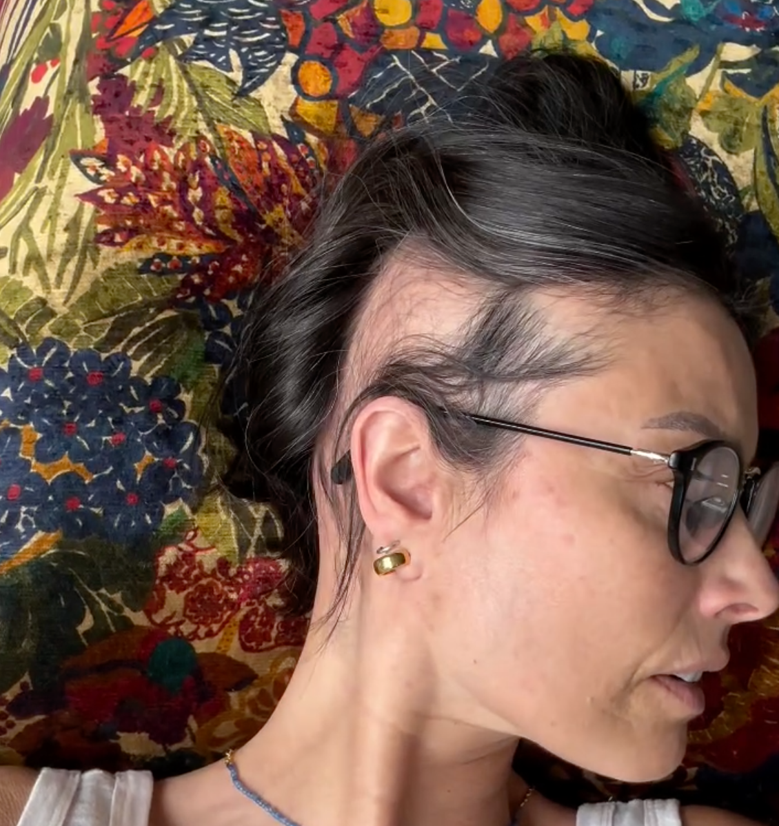 A estrela tem alopecia e uma doença auto-imune
