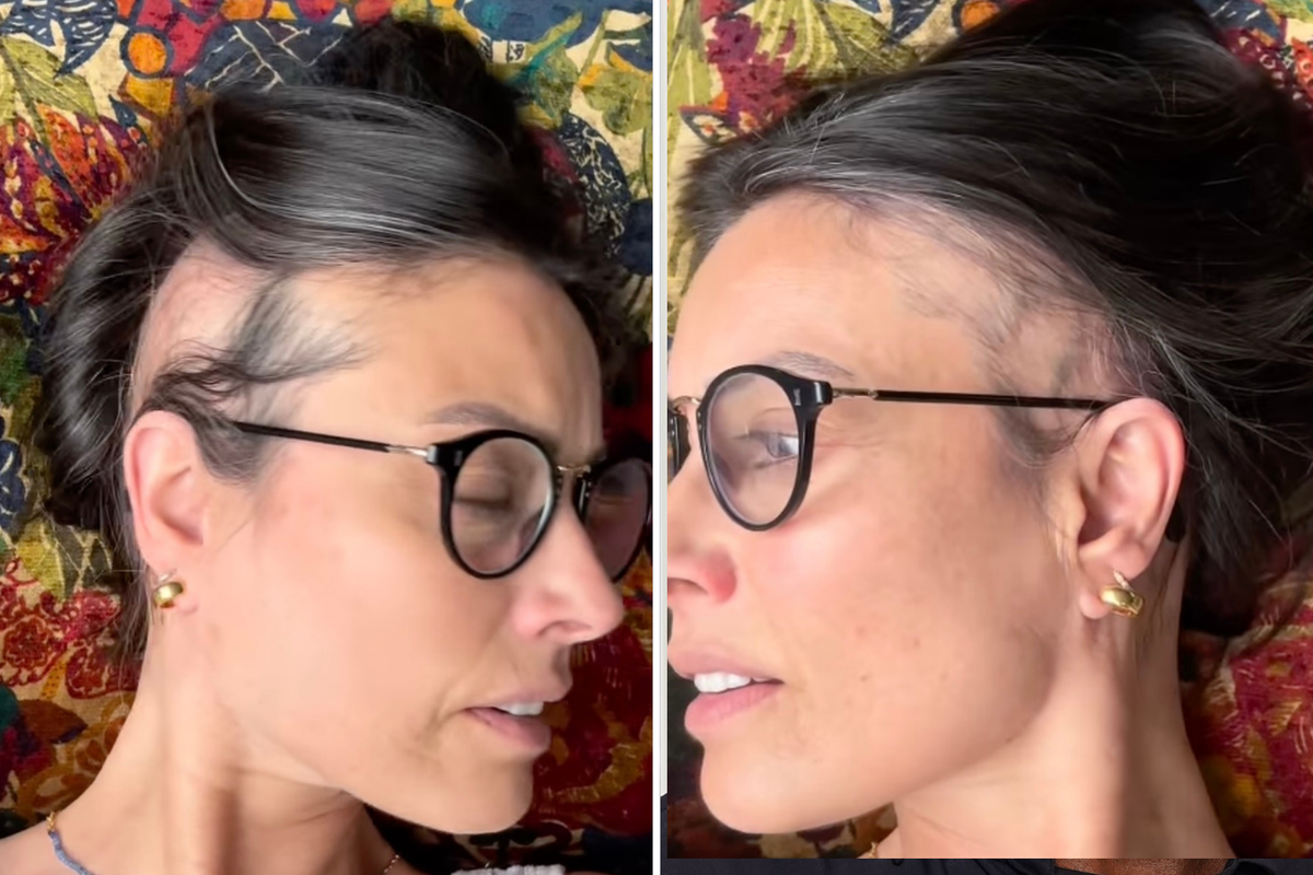 What is alopecia? Experts explain the hair loss condition after Melanie Sykes update What is alopecia? Experts explain the hair loss condition after Melanie Sykes update
