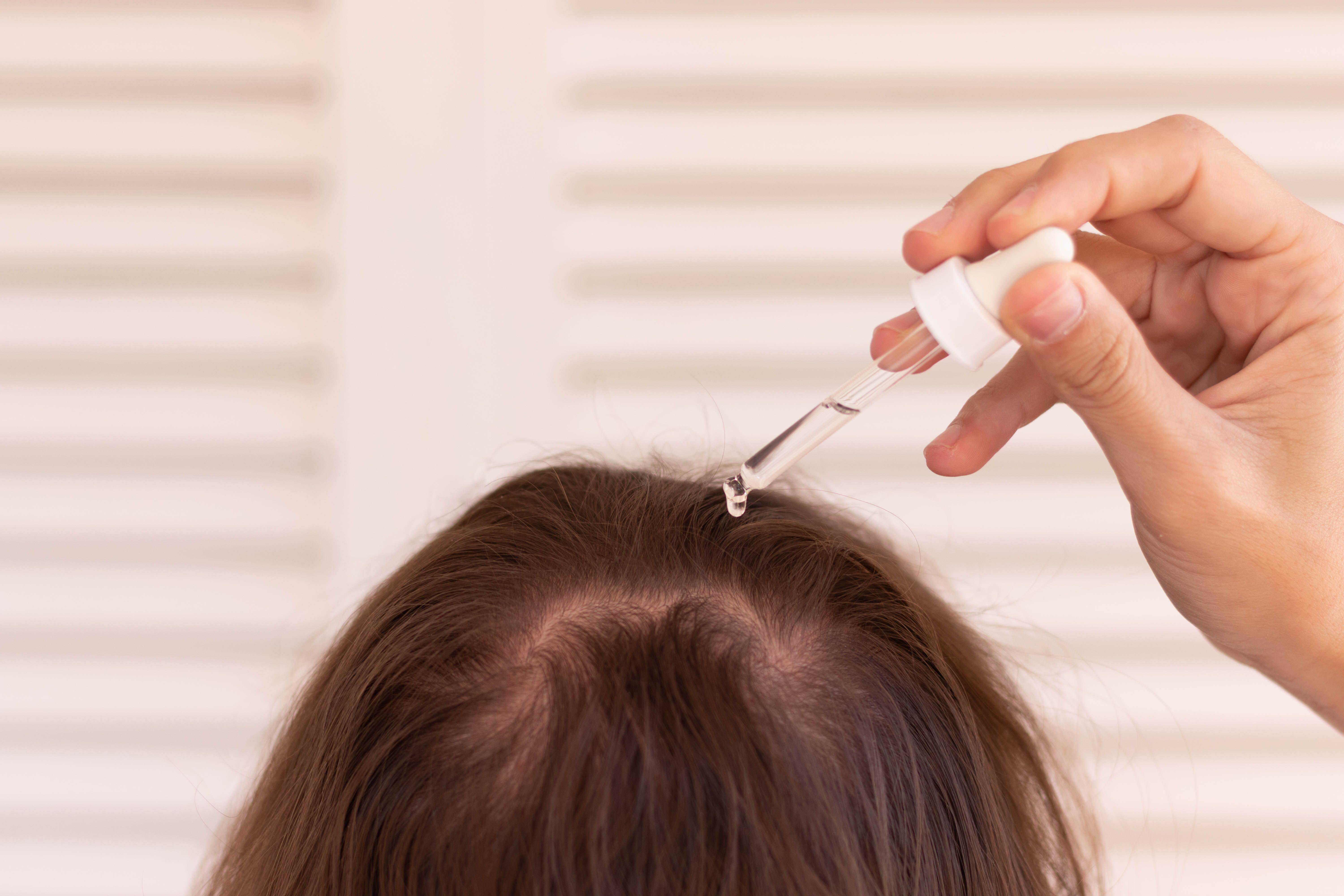 Topical minoxidil can be effective for hair loss