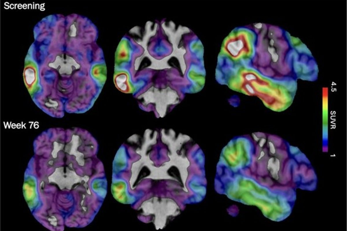 Experimental Drug Diranersen Lowers Tau but Shows Mixed Results on Cognitive Decline in Early Alzheimer’s Study