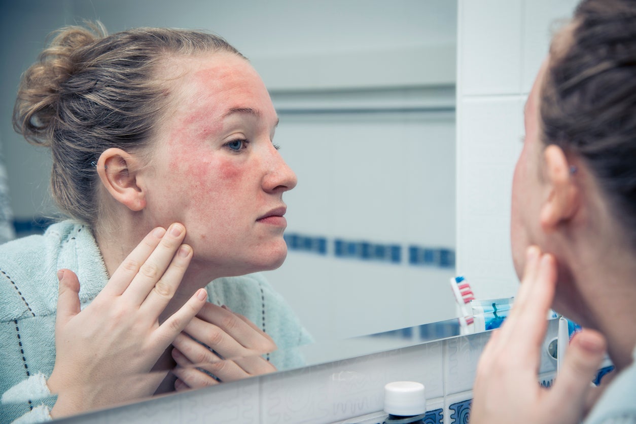 Common eczema treatment could actually make it worse, study suggests