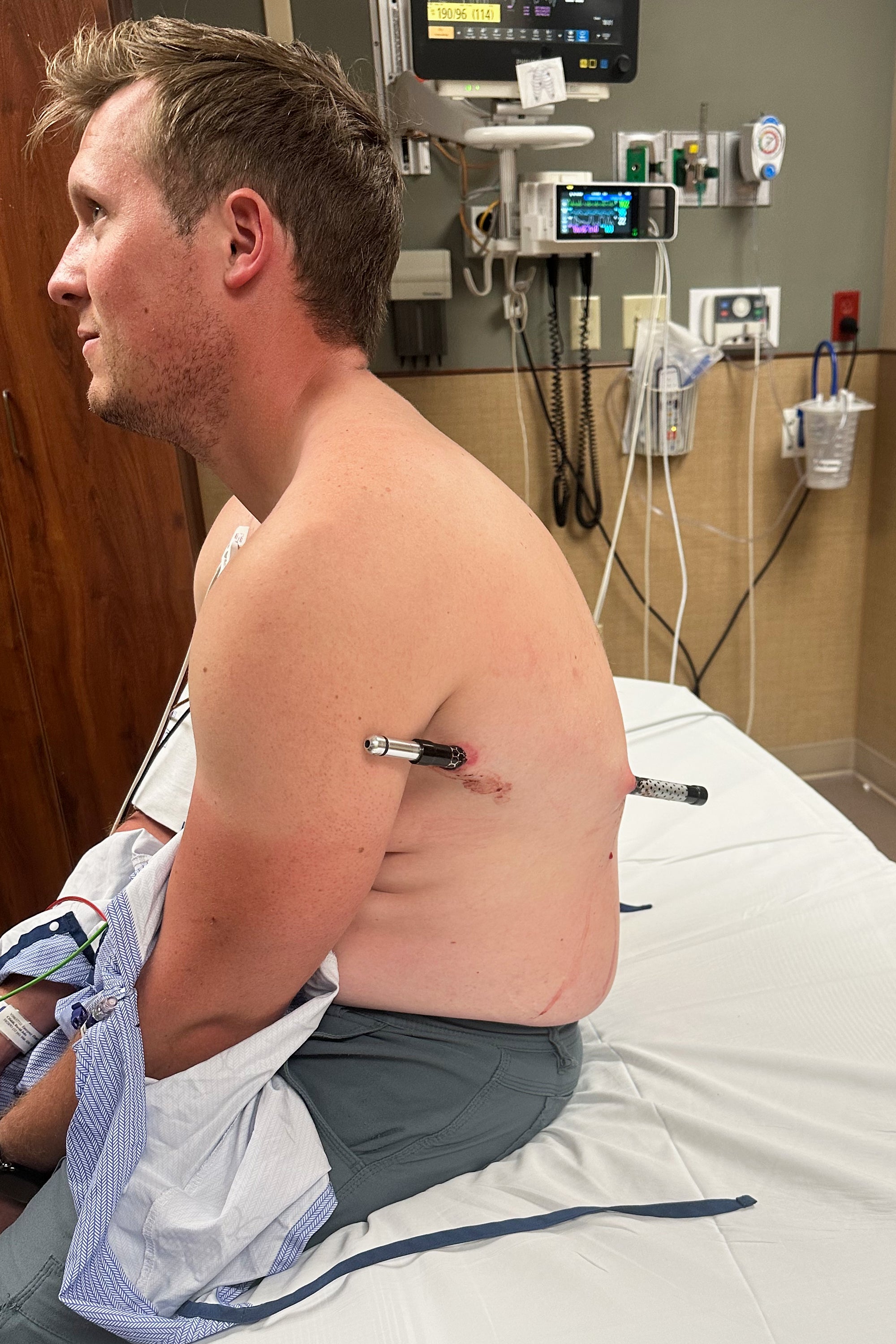 The 44-inch (112-cenimter) steel-tipped rod passed done nan soma beneath Cifaldi’s near arm, missing immoderate captious organs, and protruded from his back