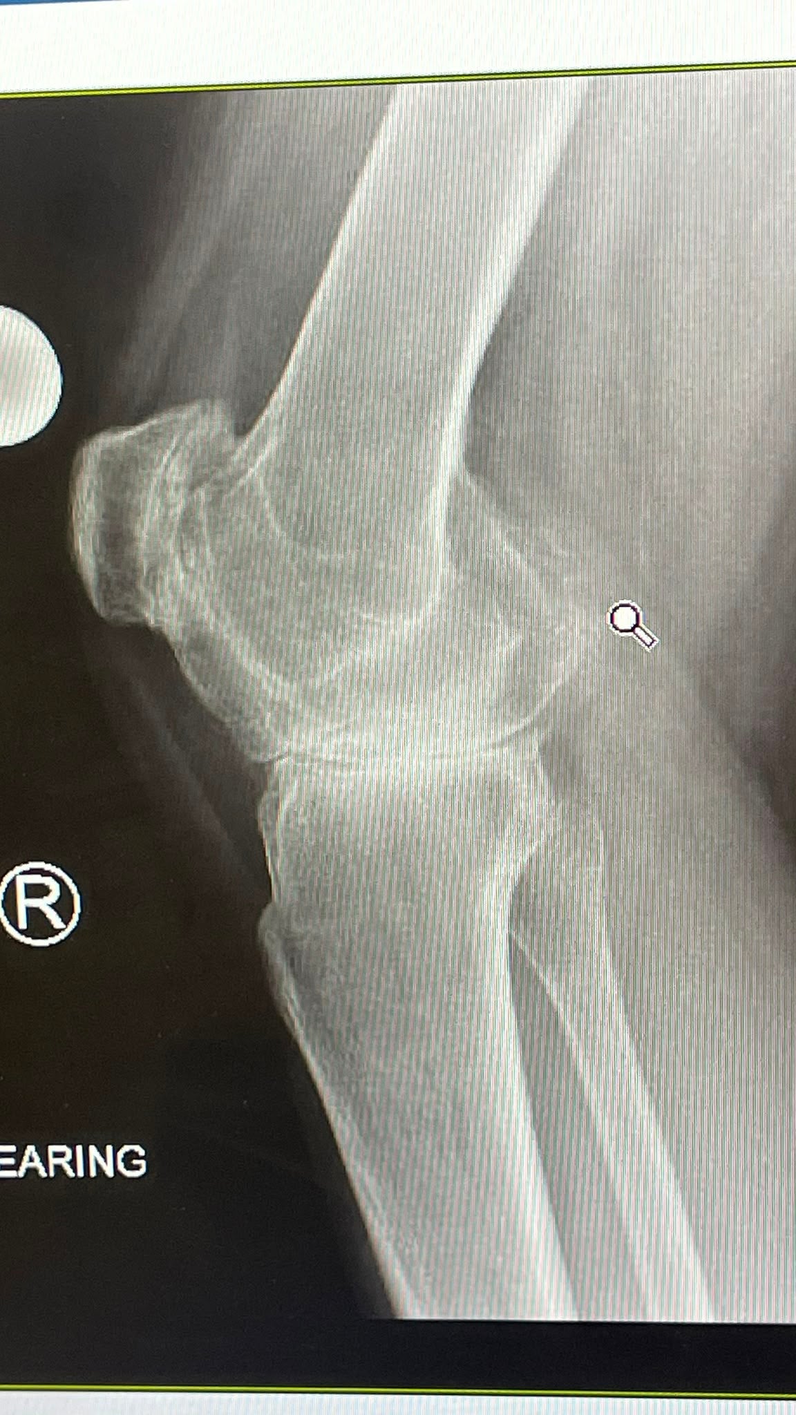 An X-ray of Phoebe’s knee