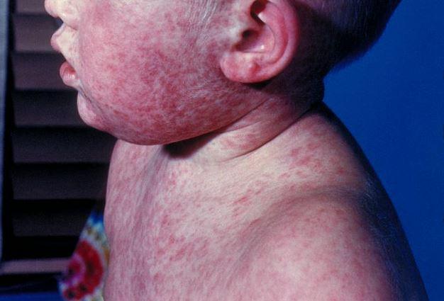 Pennsylvania reports first measles deaths in 35 years
