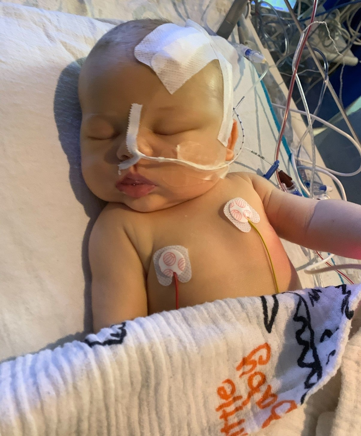 Newborn diagnosed with brain tumour after doctors spot tiny detail on fingernail