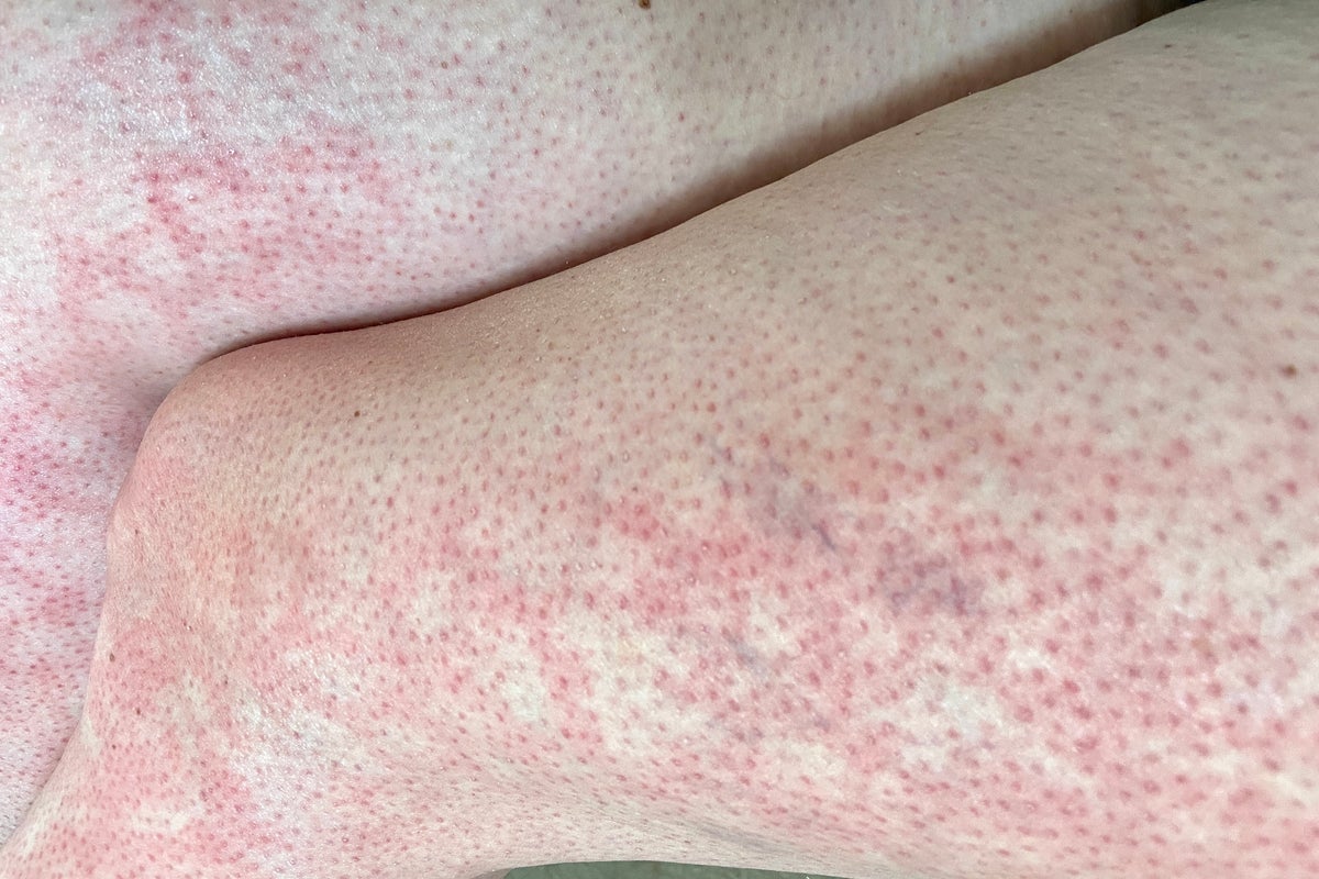 Doctors issue warning after children suffer ‘toasted skin syndrome’ from overusing devices Doctors issue warning after children suffer ‘toasted skin syndrome’ from overusing devices