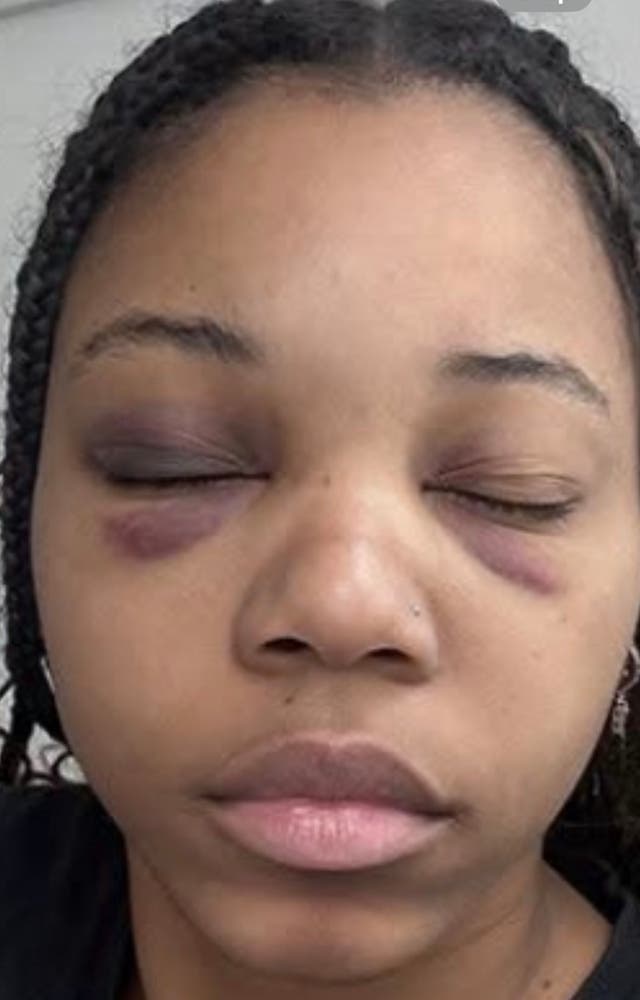 Bonner, who faces misdemeanor charges of disorderly conduct and hindering or interfering with police over the incident, was left with a bruised face, according to a photo shared by her lawyer