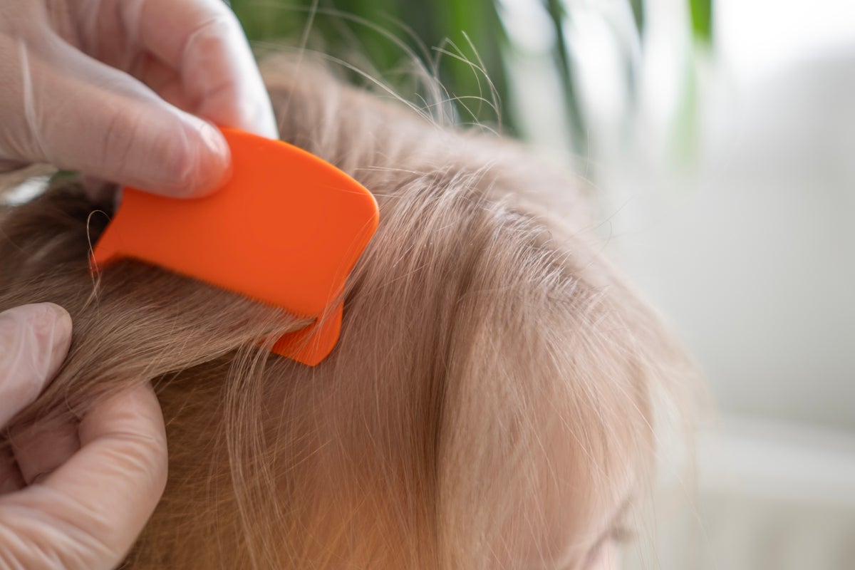 Pediatrician explains how to treat head lice and ‘alternative remedies’ to avoid Pediatrician explains how to treat head lice and ‘alternative remedies’ to avoid