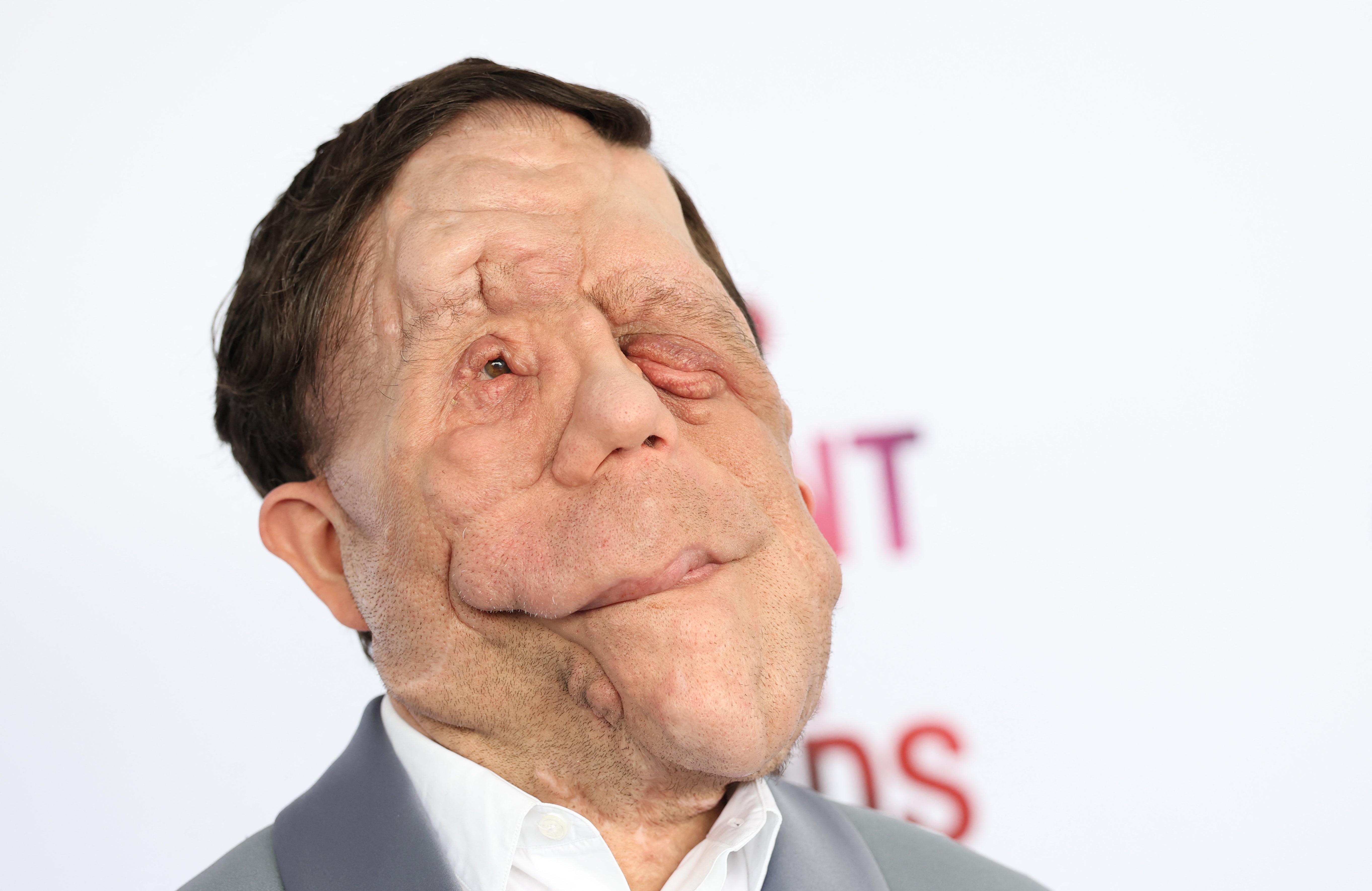 Adam Pearson reveals he was hit by car on way to Under the Skin audition - The Independent