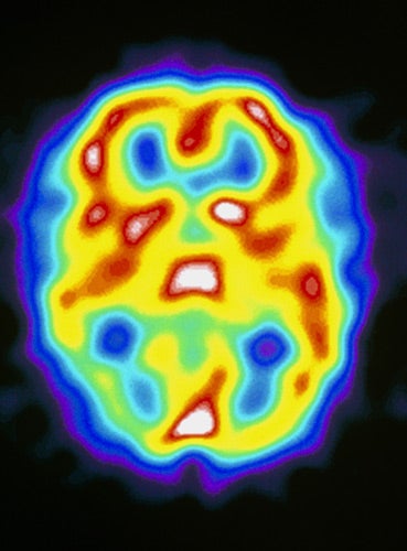 High activity: a brain scan taken during a migraine attack