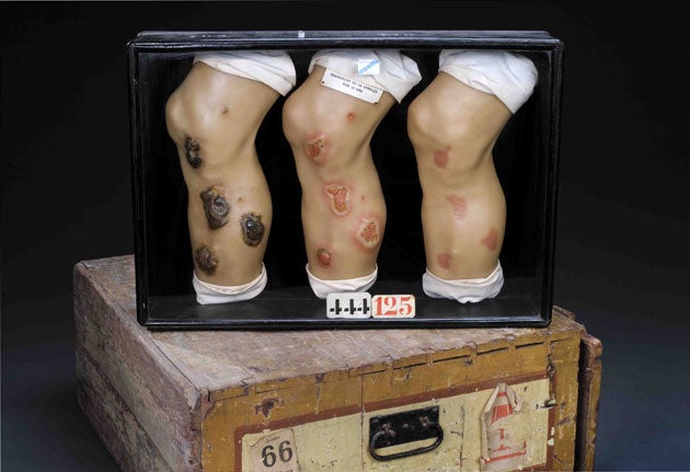 Three wax legs showing treatment of ulcers caused by syphilis