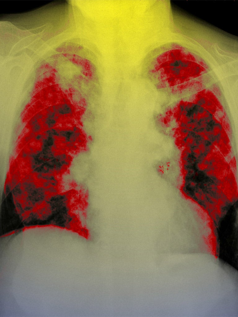 An X-ray of lung cancer, often caused by tobacco