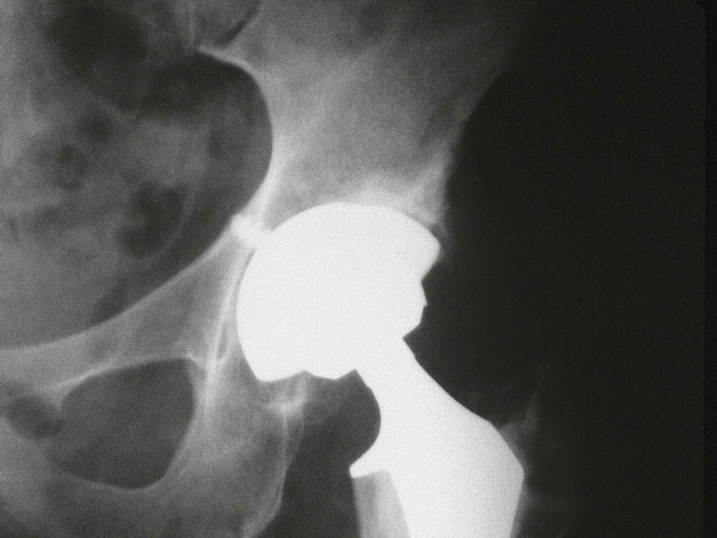 Hip implants have traditionally not had to pass any clinical trials before being used in patients