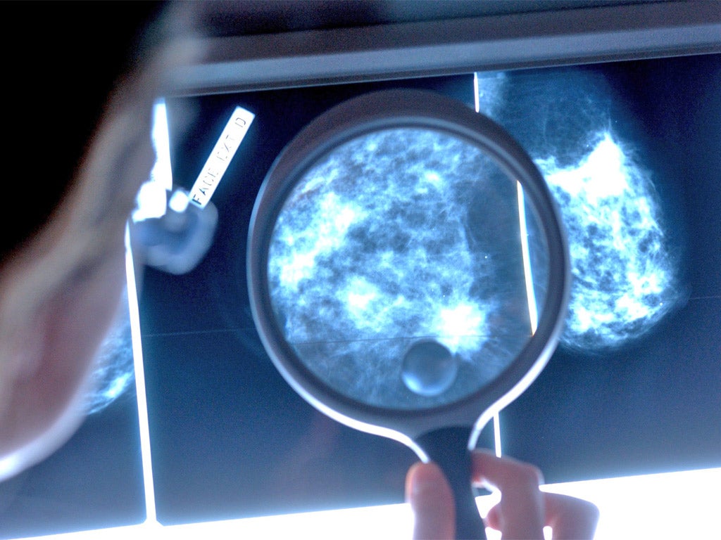 A doctor examines a mammograph of a breast cancer patient