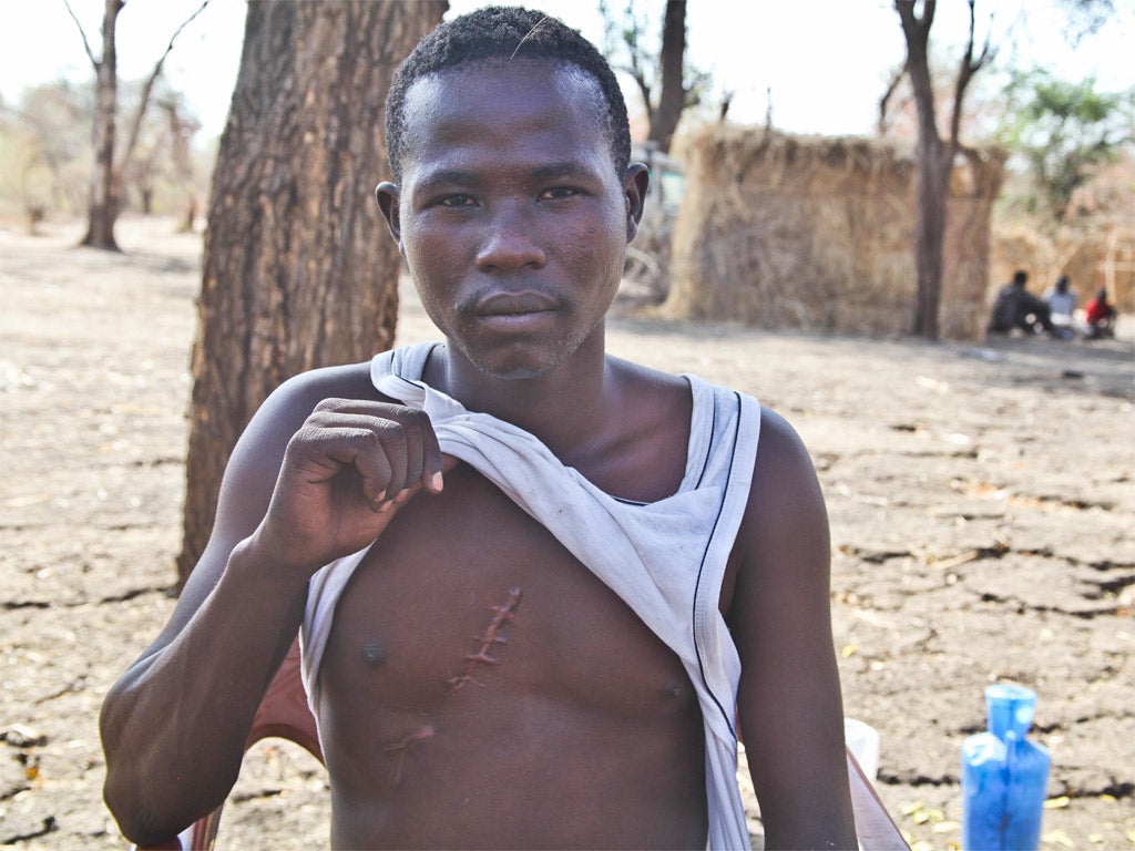 Omar Idris shows a scar from a bombing raid