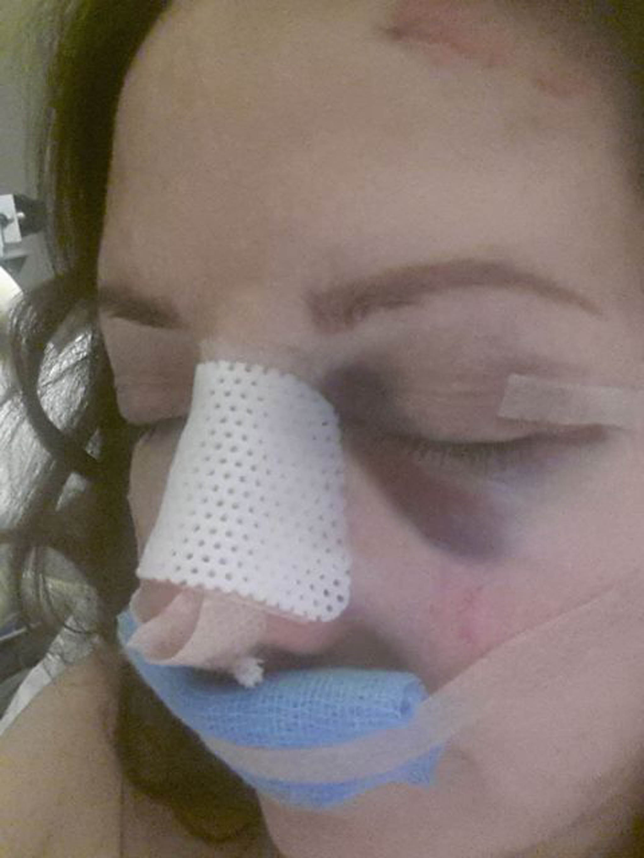 Carol Vorderman's broken nose