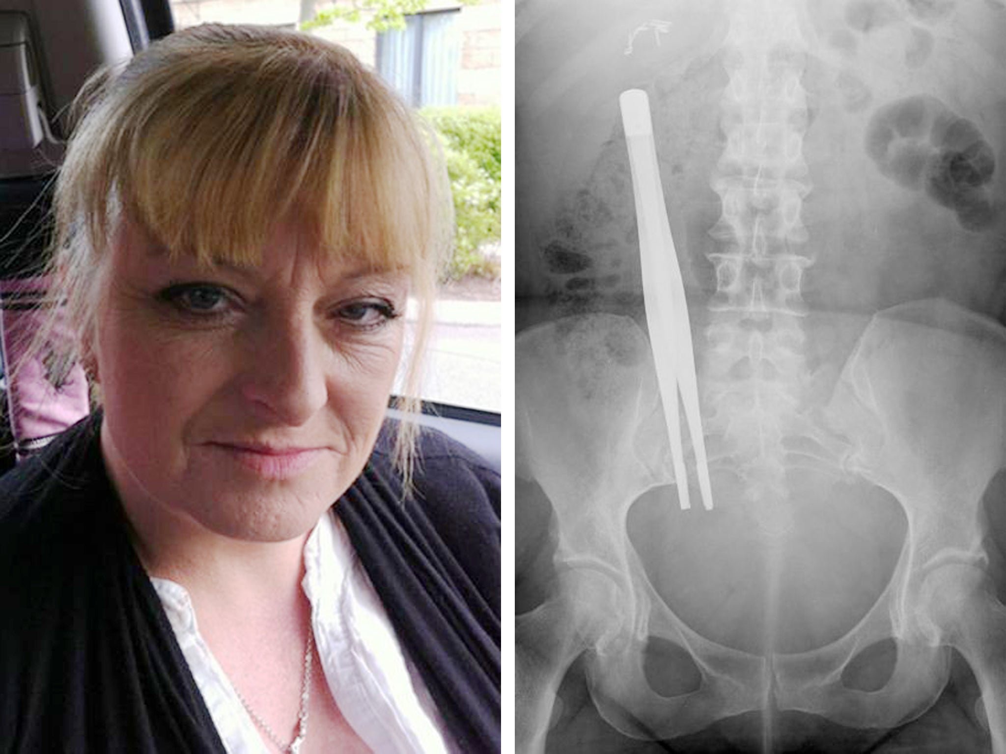 A photograph issued by Irwin Mitchell of the X-Ray showing seven-inch forceps that were left inside Donna Bowett for three months following an operation to remove her gallbladder. The mum of four has joined calls from specialist medical law experts at Irw