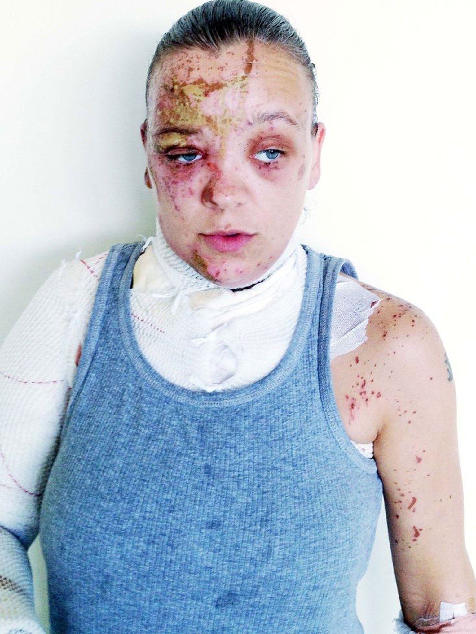 A 28-year-old - who is called Tara but has asked for her surname not to be used - was left with nasty burns after an acid attack on her doorstep