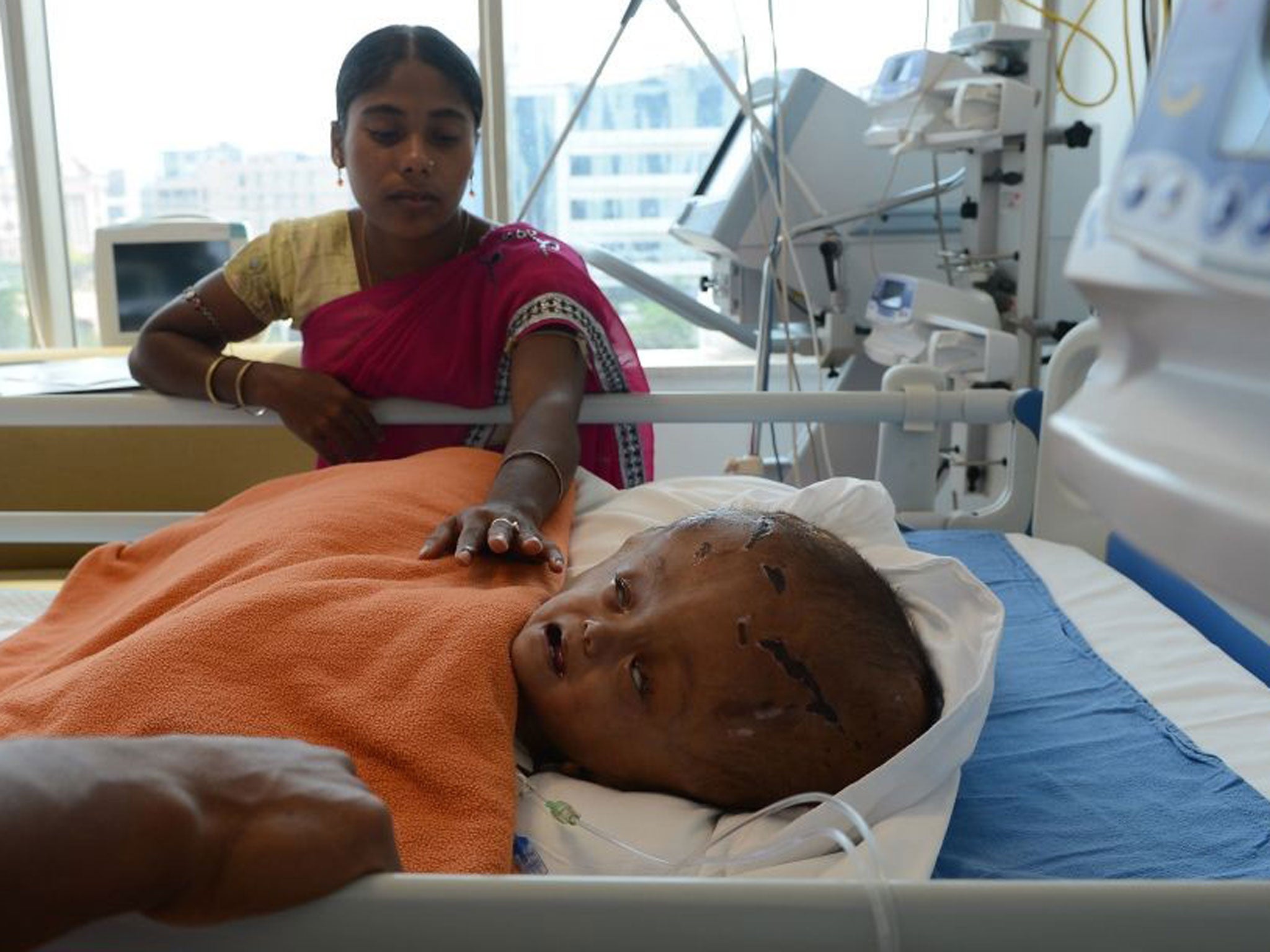 Roona Begum with her mother Fatema Khatun after life-saving surgery yesterday