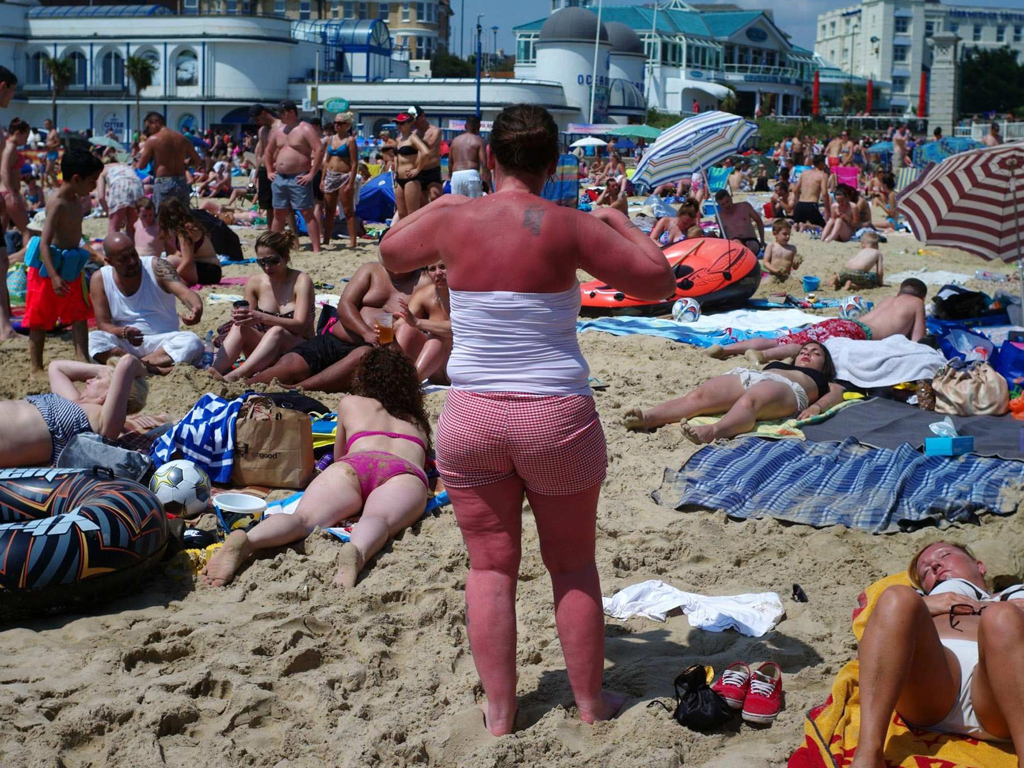 Sunburn can increase the risk of developing melanoma, the deadly form of skin cancer