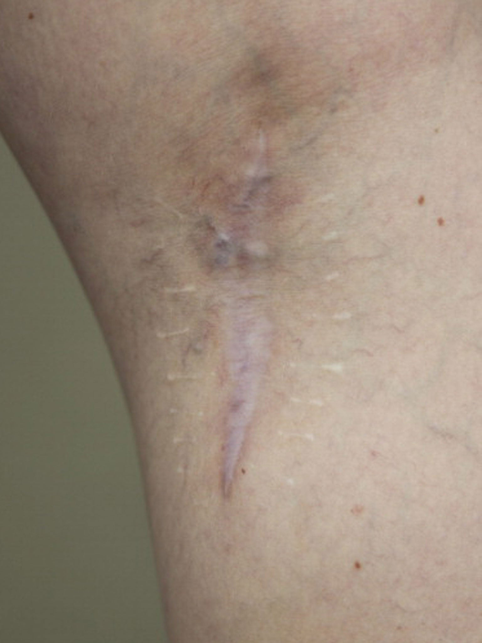 A Melanoma survivor's scar where the mole was removed