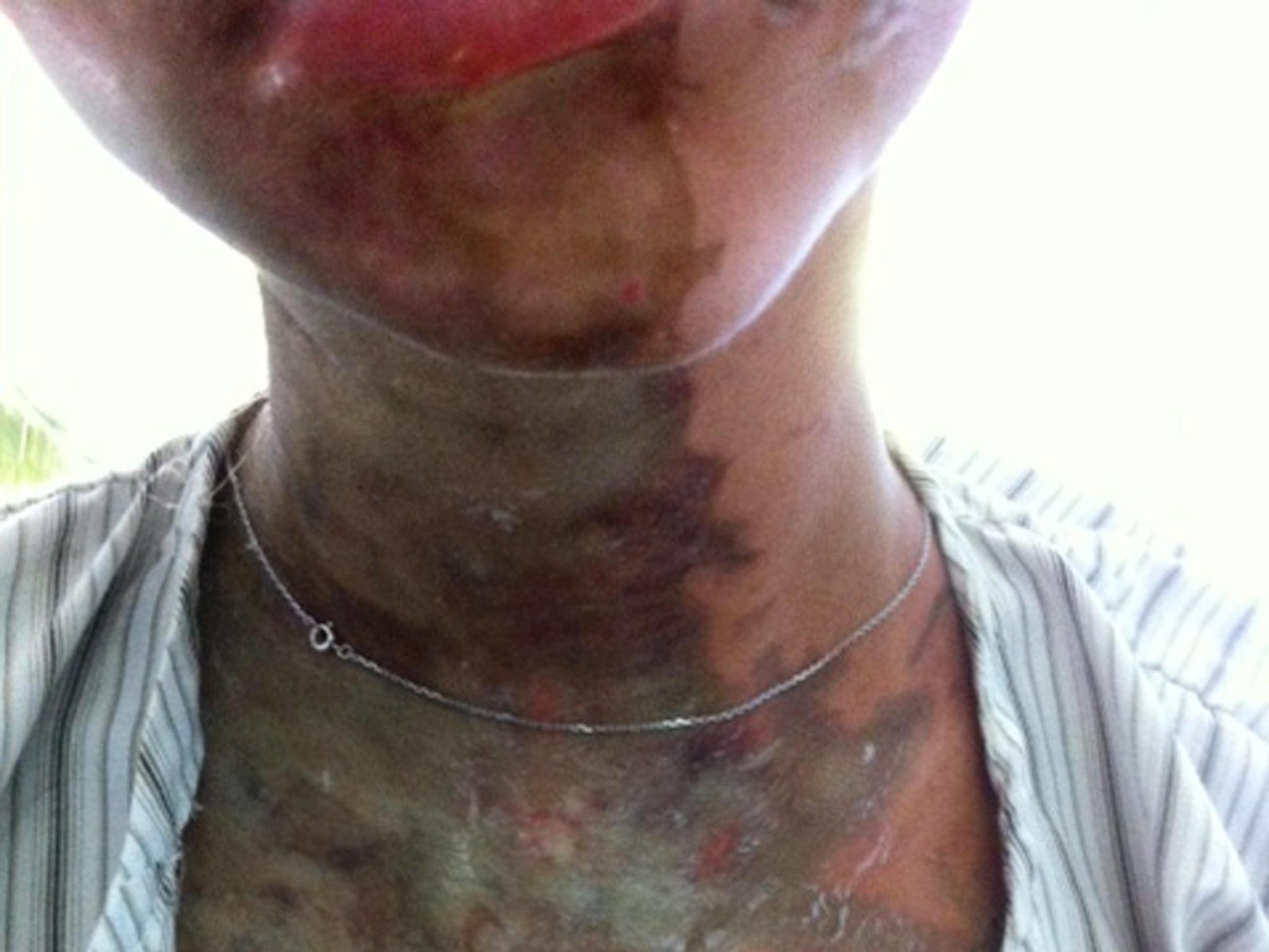 Family handout photo of one of the two British teenagers attacked with acid on Zanzibar.