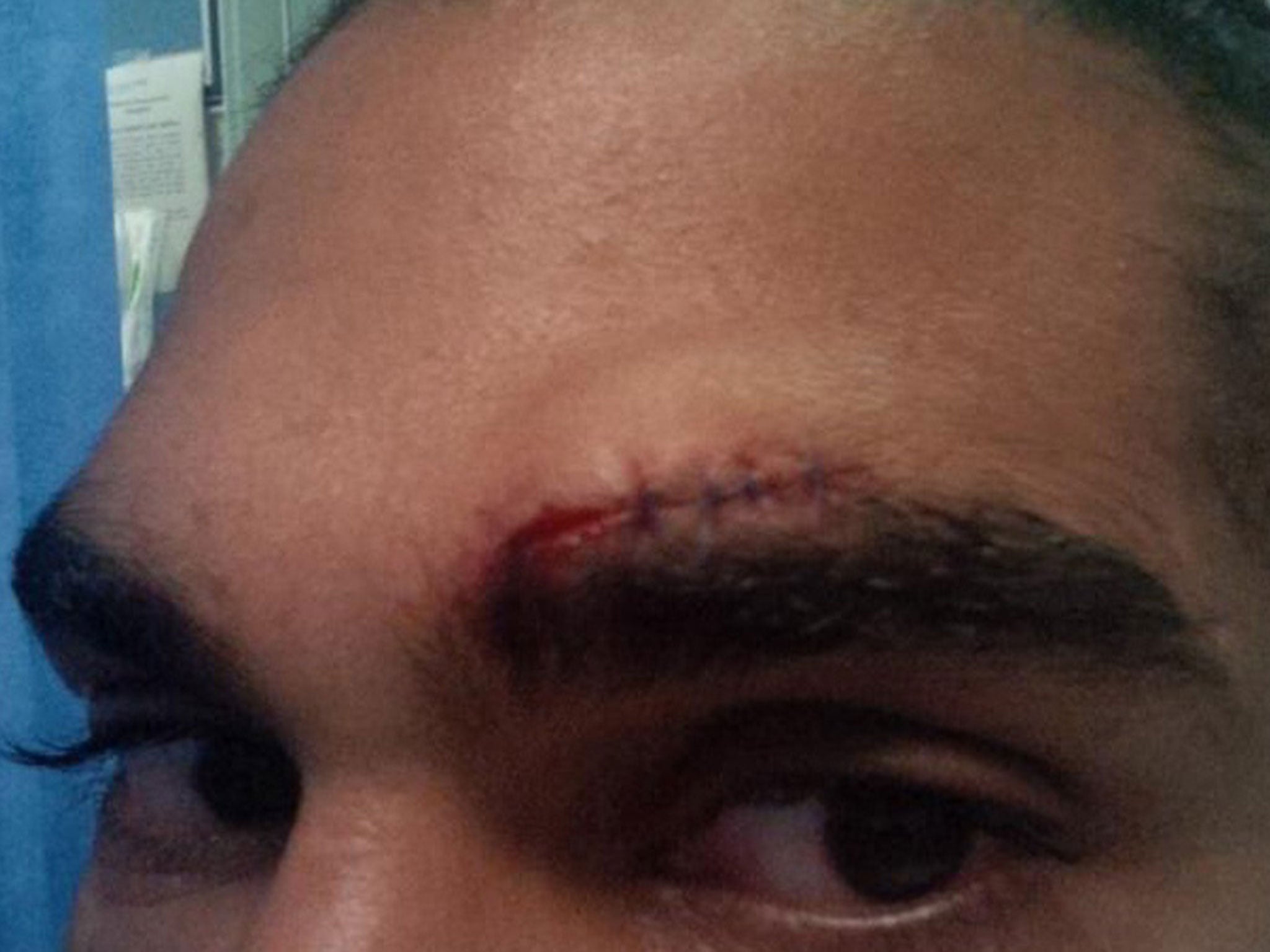 Haye posted this picture to show the severity of the cut