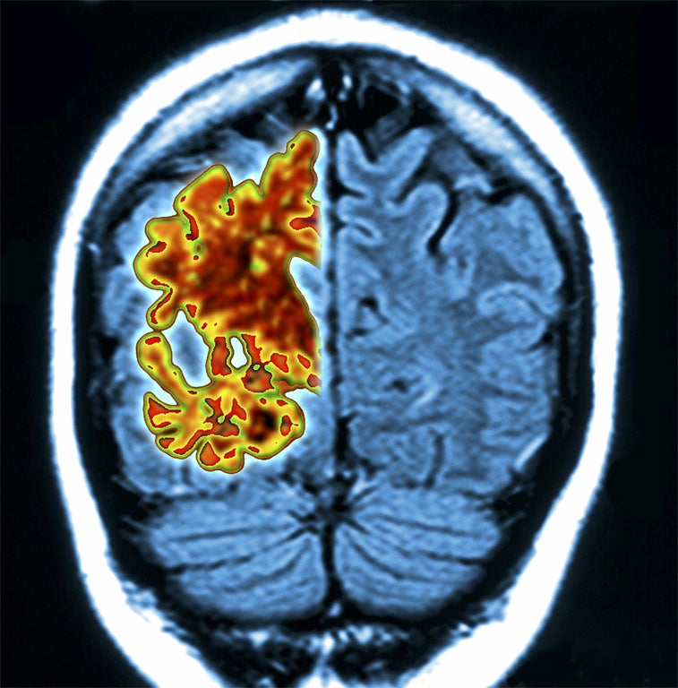 Computer graphic of a vertical (coronal) slice through the brain of an Alzheimer's patient