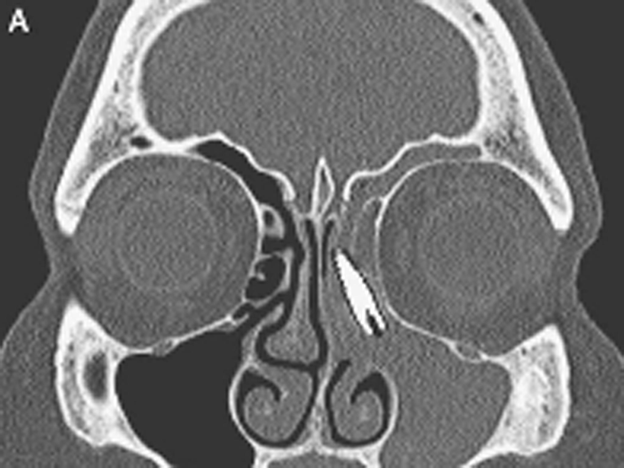 An X-ray showing the dental implant inside the sinus