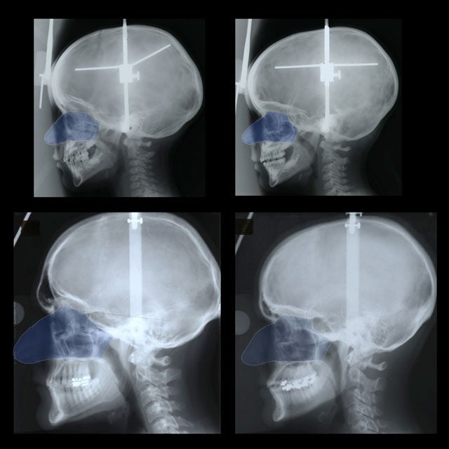 An image from the study differences in male and female nose sizes before and after puberty.