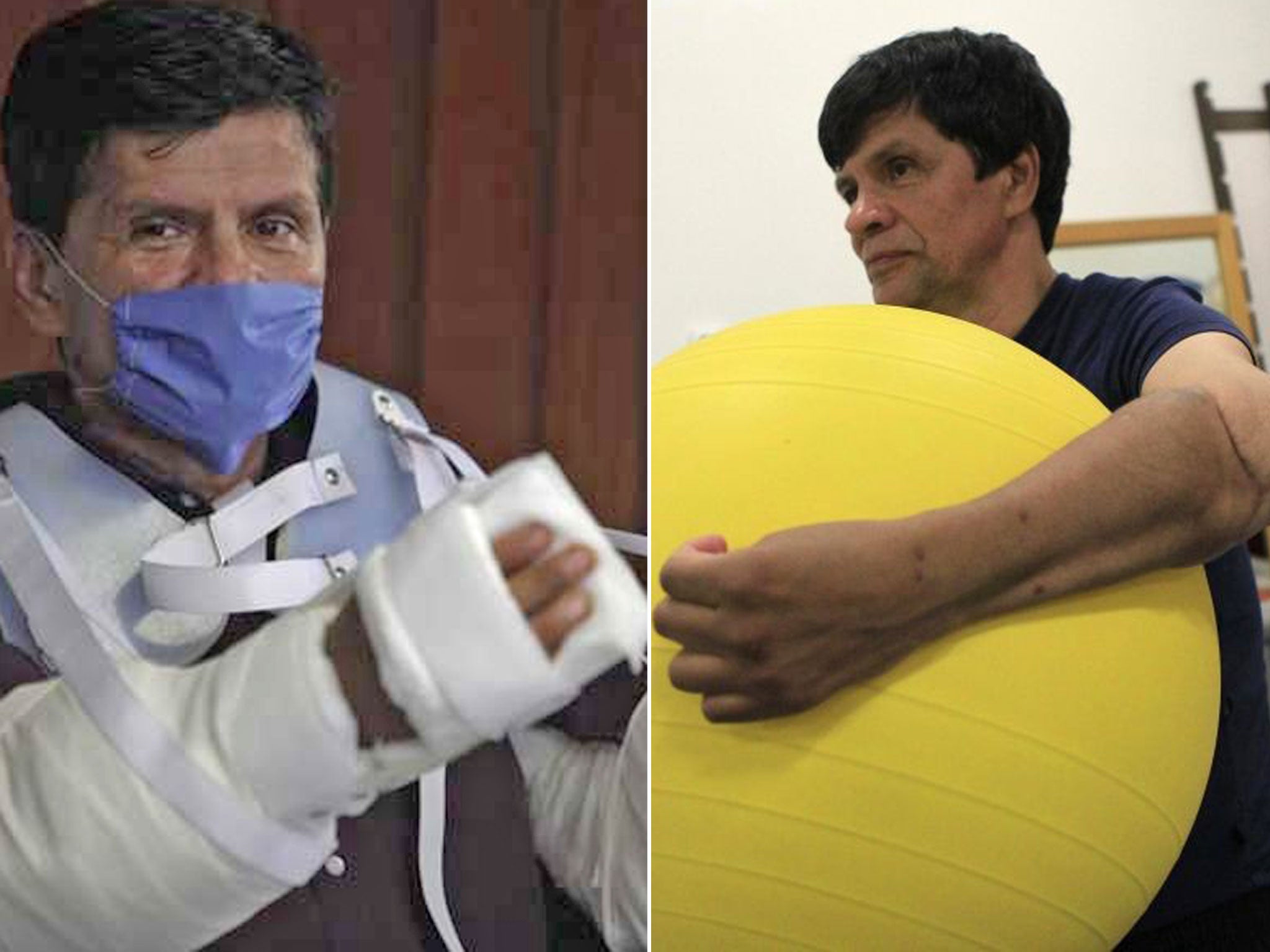 Gabriel Granados after the 17-hour surgery, left, and recovered during physiotherapy