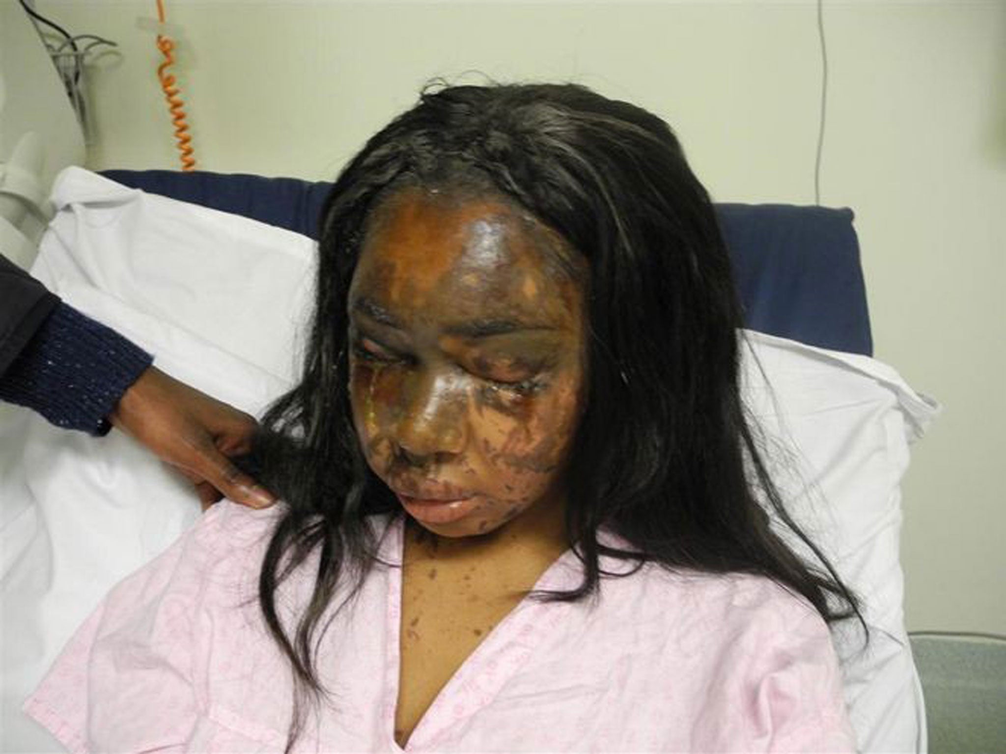 Naomi Oni after she acid thrown in her face by Mary Konye