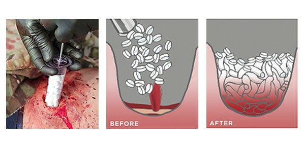 How the XStar works to seal a wound. Image credit: RevMedX