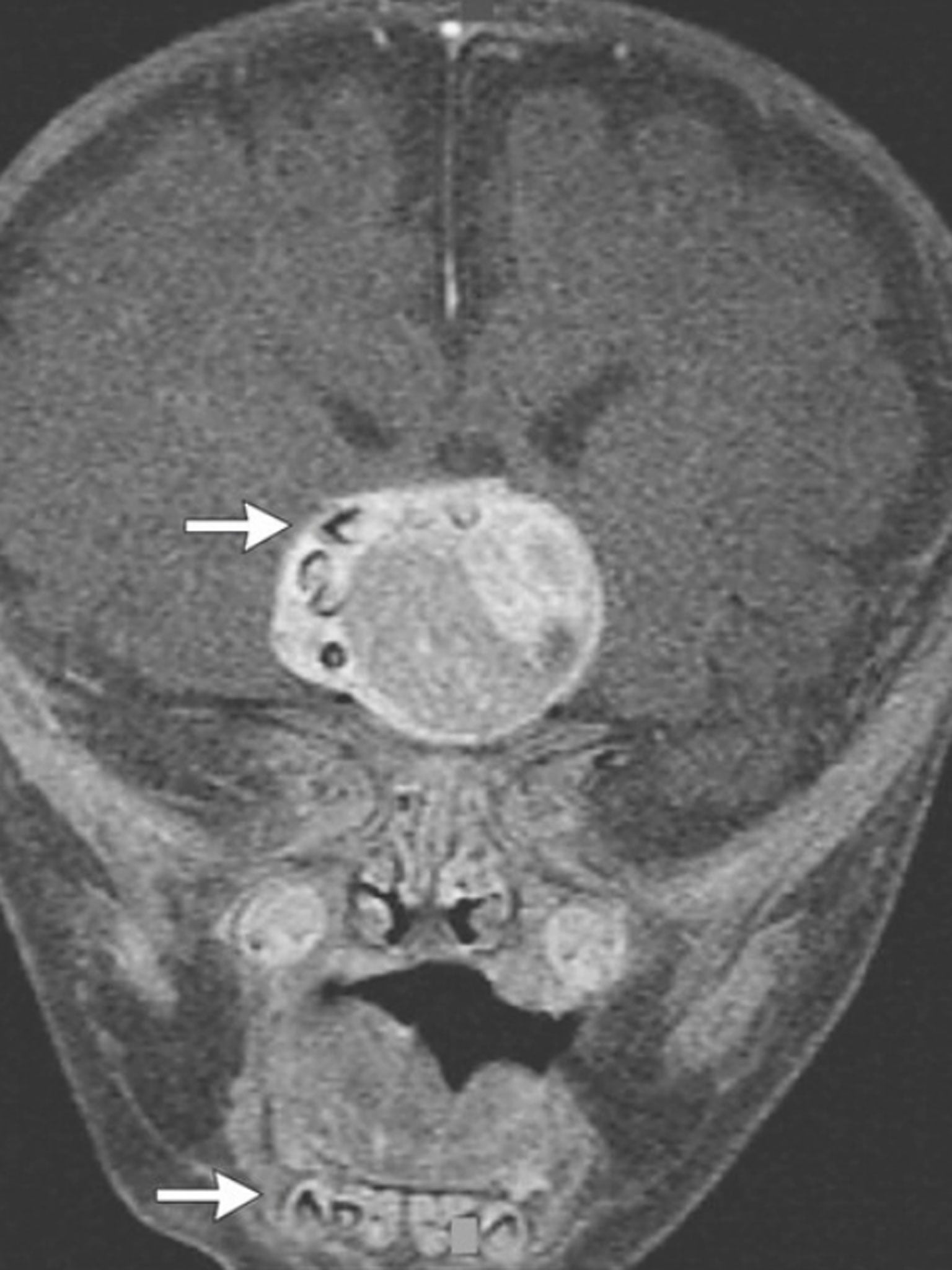 An MRI scan revealed the teeth inside the tumour, which resembled those in the lower jaw