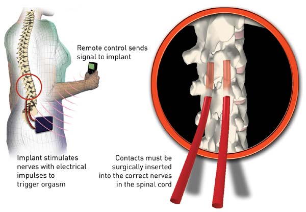 Spinal implant is controlled via remote control (Picture: New Scientist)