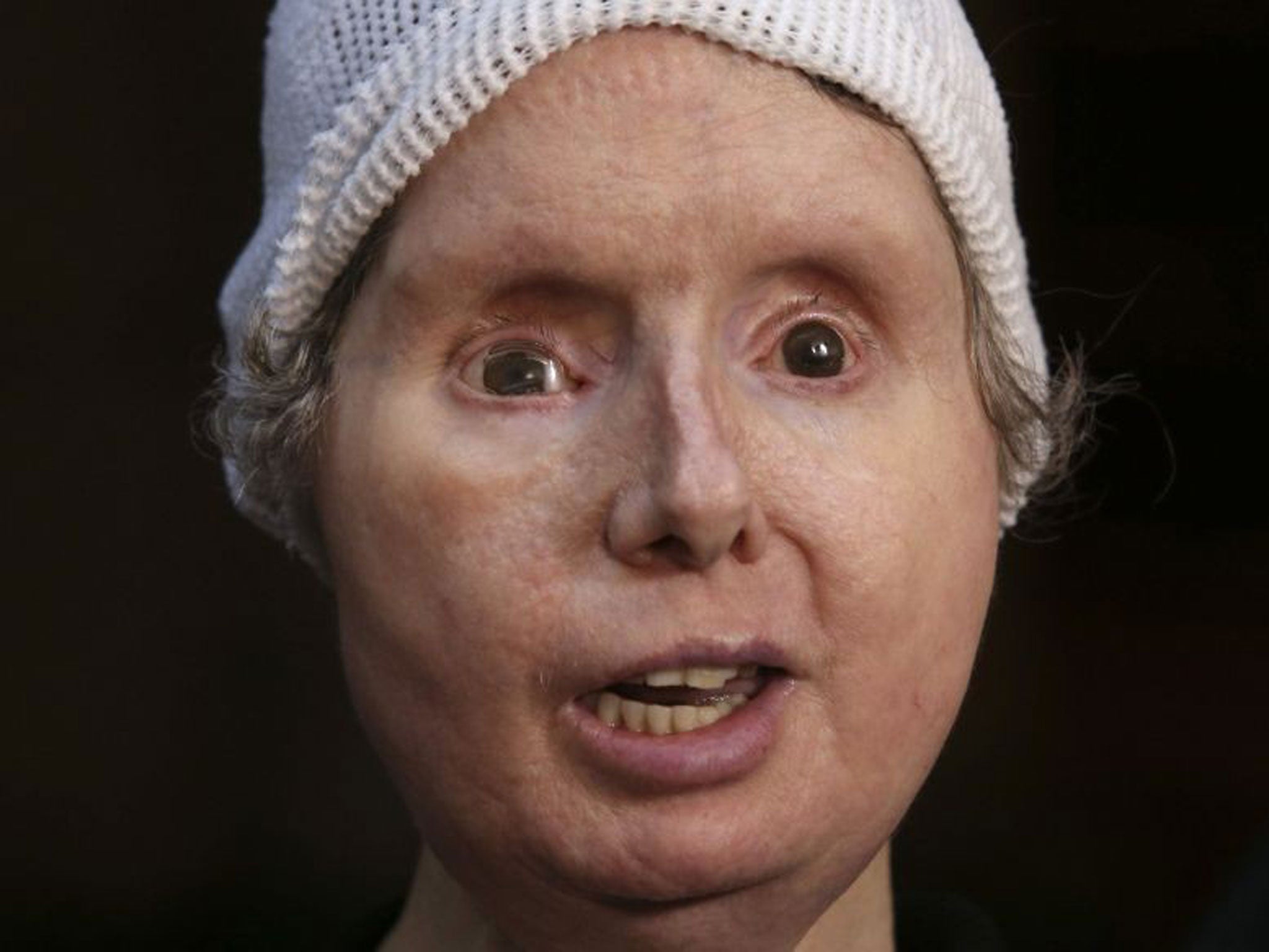 Charla Nash had her face and hands ripped off in the 2009 attack