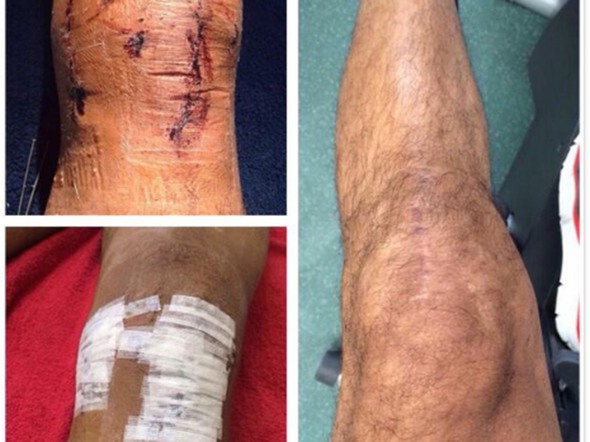 Theo Walcott posts a picture of his injured knee on Twitter