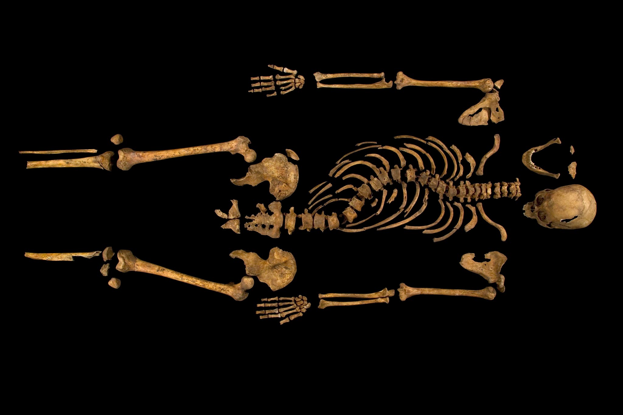 Richard III’s skeleton show his scoliosis