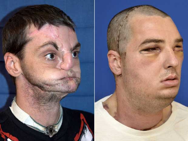 Richard Norris is seen before (left) and immediately after his face transplant surgery